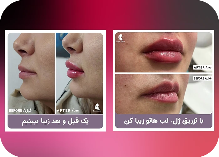 نمونه کار های تزریق فیلر در کلینیک زیبایی لیزر لند