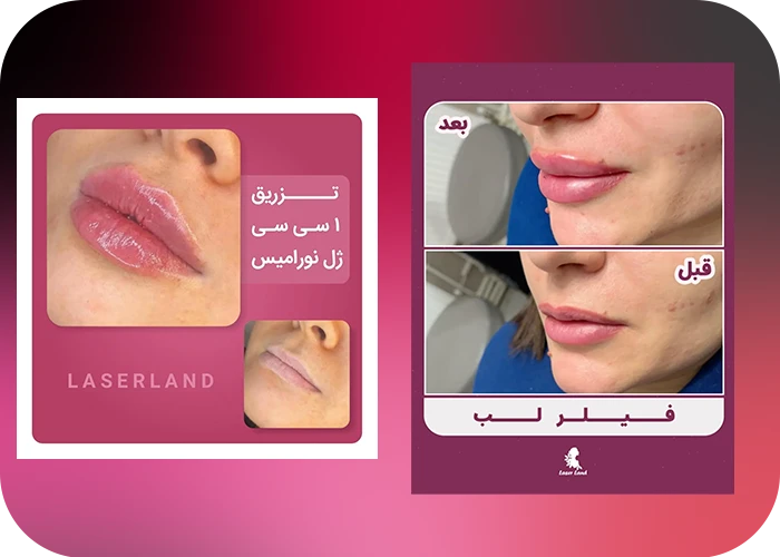 نمونه کار تزریق فیلر لب در کلینیک زیبایی لیزر لند