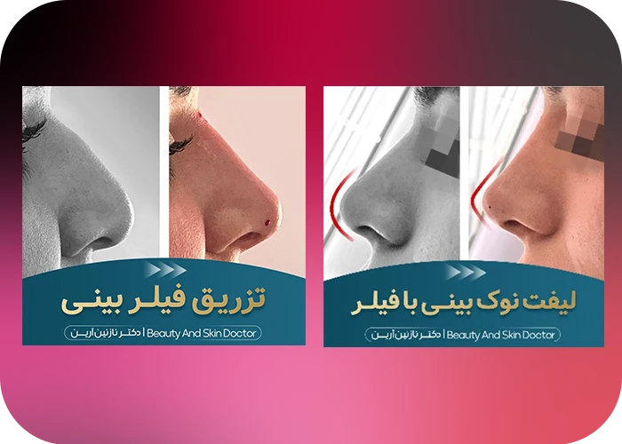 نمونه کار تزریق فیلر بینی دکتر آرین - کرمانشاه