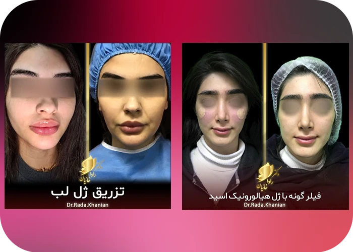 نمونه کار تزریق فیلر گونه و فیلر لب دکتر رادا خانیان