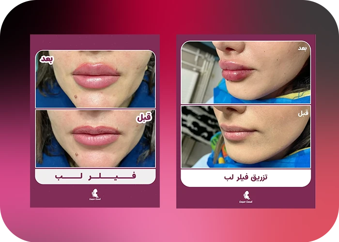 نمونه کار تزریق فیلر لب کلینیک لیزرلند