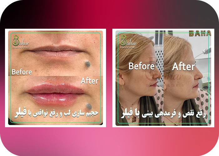 نمونه کار تزریق فیلر لب و بینی در کلینیک زیبایی بهار