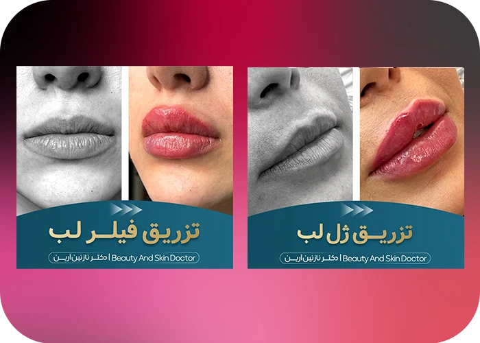 نمونه کار تزریق فیلر لب دکتر آرین
