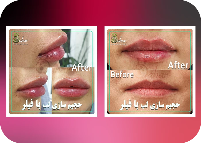 نمونه کار تزریق فیلر در کلینیک زیبایی بهار