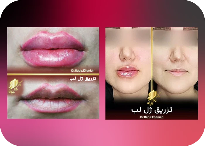 نمونه کار تزریق فیلر لب دکتر رادا خانیان