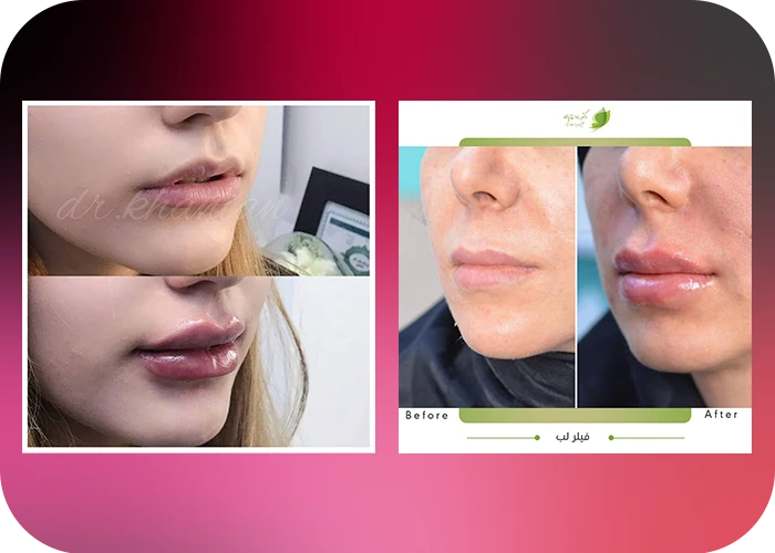 نمونه کار فیلر لب دکتر رادا خانیان