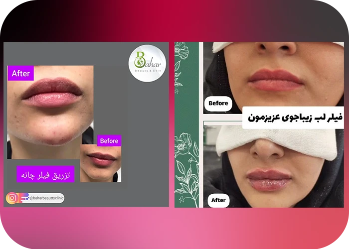 نمونه کار تزریق فیلر لب و چانه در کلینیک زیبایی بهار