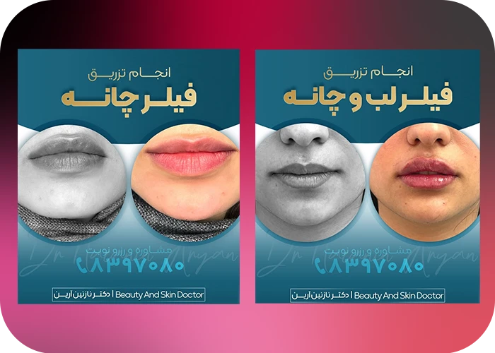 نمونه کار تزریق فیلر چانه دکتر نازنین آرین