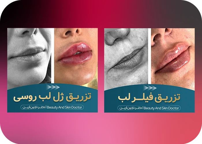 نمونه کار تزریق فیلر لب - لب روسی دکتر نازنین آزین