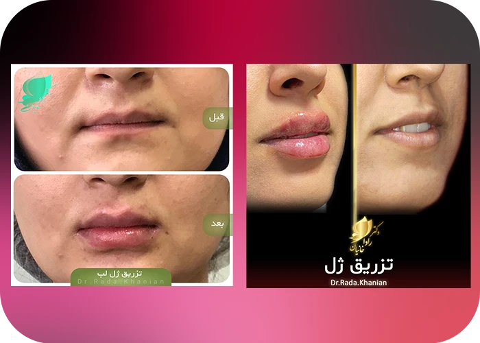 نمونه کار تزریق ژل لب و فیلر دکتر رادا خانیان
