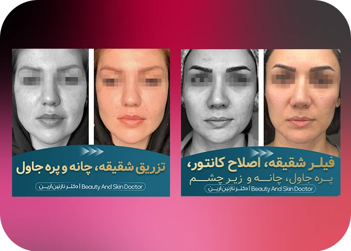 نمونه کار - تزریق فیلر شقیقه دکتر آرین