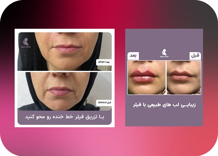 نمونه کار تزریق فیلر لب و خط خنده کلینیک لیزر لند