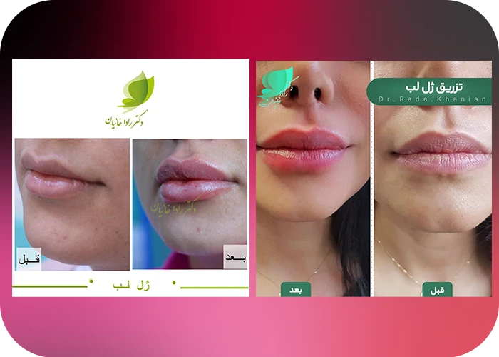 نمونه کار تزریق ژل لب دکتر رادا خانیان