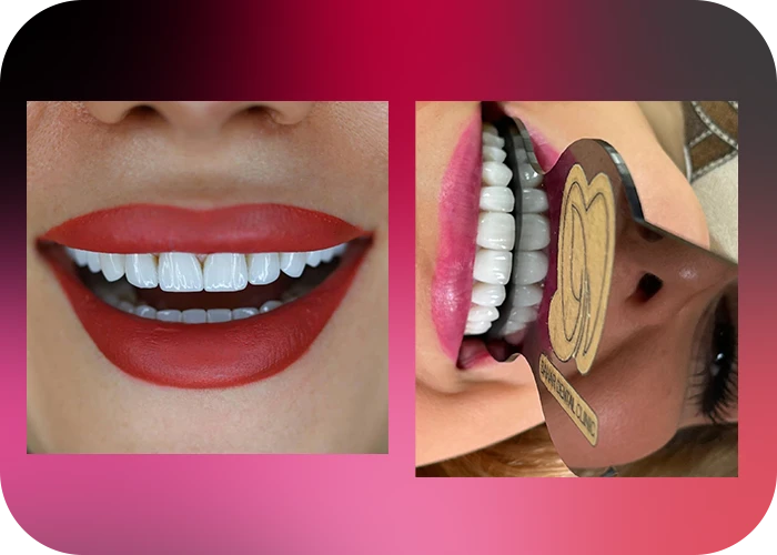 نمونه کار لمینت کلینیک دندانپزشکی بهار - 1