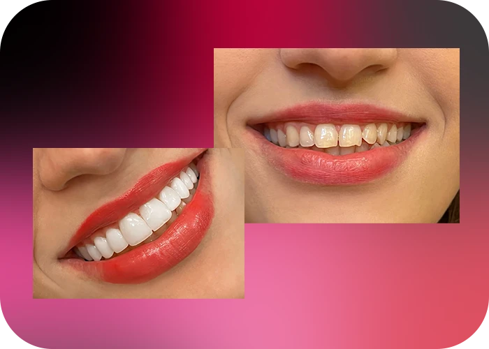 نمونه کار لمینت کلینیک دندانپزشکی دکتر یگانه موسوی زاده - 3