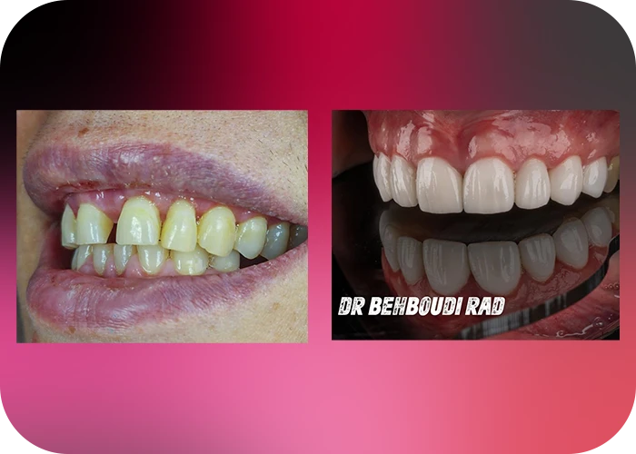 نمونه کار لمینت کلینیک دندانپزشکی دکتر هاجر بهبودی راد - 2