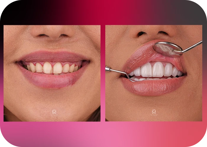 نمونه کار لمینت کلینیک دندانپزشکی بارانا - 5