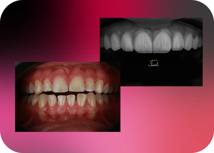 نمونه کار لمینت کلینیک دندانپزشکی دکتر فرید - 5