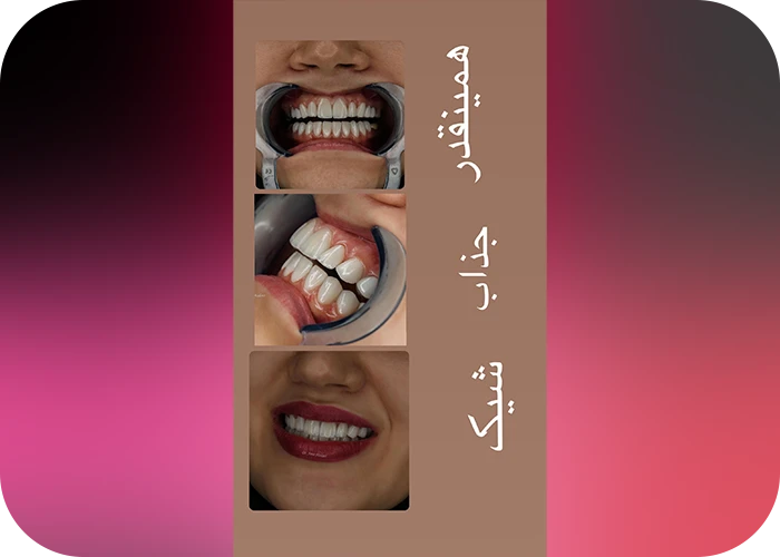 نمونه کار لمینت کلینیک دندانپزشکی ماهان - 2