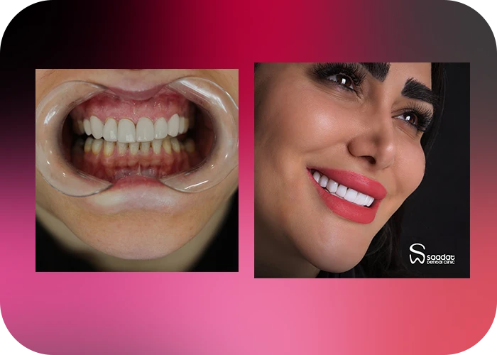 نمونه کار لمینت کلینیک دندانپزشکی سعادت - 4