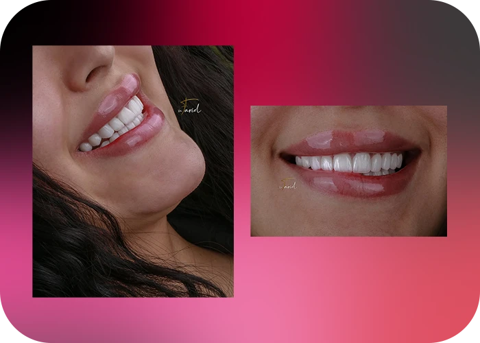 نمونه کار لمینت کلینیک دندانپزشکی دکتر فرید - 1