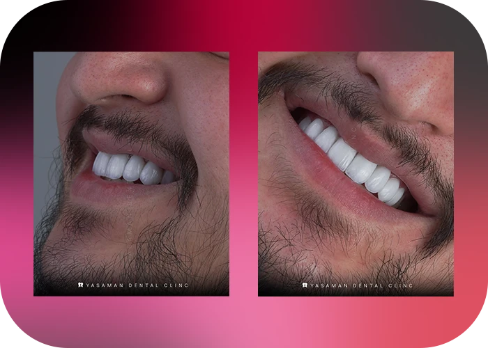 نمونه کار لمینت کلینیک دندانپزشکی یاسمن-2