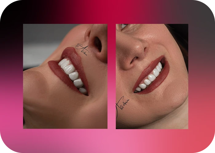 نمونه کار لمینت کلینیک دندانپزشکی دکتر علی عزیزی - 2