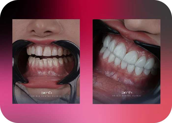 نمونه کار لمینت کلینیک دندانپزشکی دکتر نیک-2