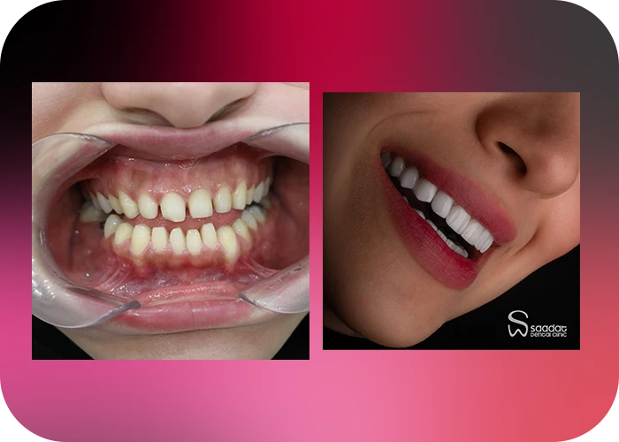 نمونه کار لمینت کلینیک دندانپزشکی سعادت - 2