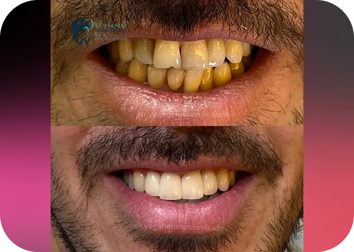 نمونه کار لمینت کلینیک دندانپزشکی دکتر یگانه موسوی زاده - 2