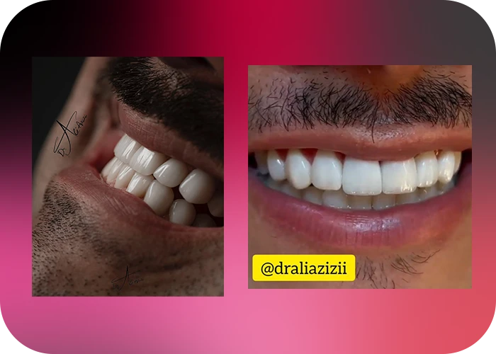 نمونه کار لمینت کلینیک دندانپزشکی دکتر علی عزیزی - 4