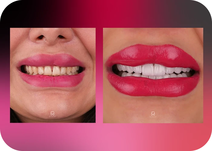 نمونه کار لمینت کلینیک دندانپزشکی بارانا - 2