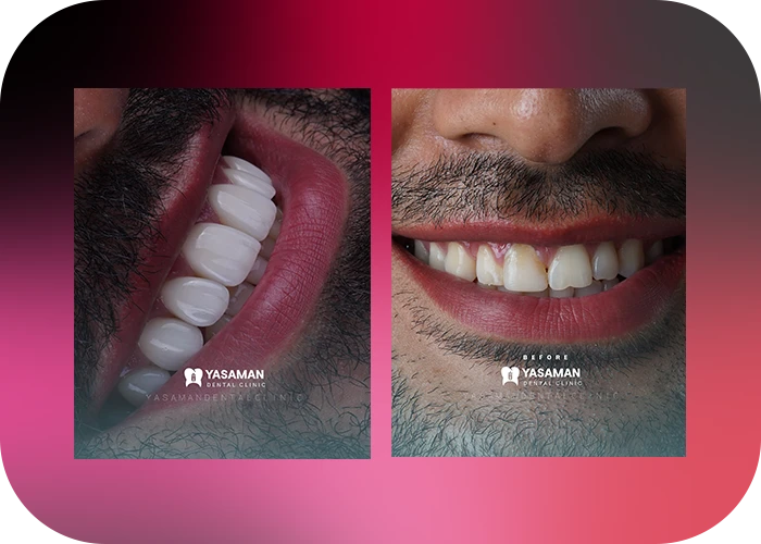 نمونه کار لمینت کلینیک دندانپزشکی یاسمن-3