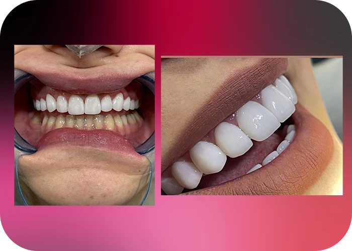 نمونه کار لمینت کلینیک دندانپزشکی بهار - 2