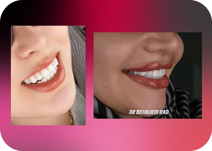 نمونه کار لمینت کلینیک دندانپزشکی دکتر هاجر بهبودی راد - 4