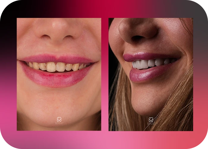 نمونه کار لمینت کلینیک دندانپزشکی بارانا - 4