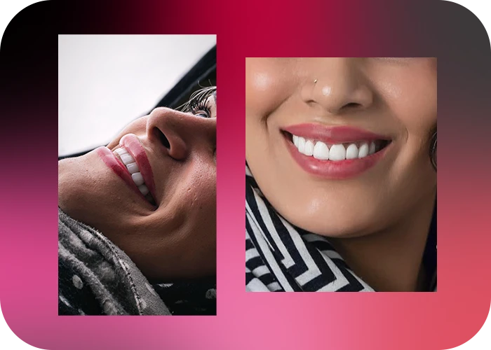 نمونه کار لمینت کلینیک دندانپزشکی دکتر علی عزیزی - 3