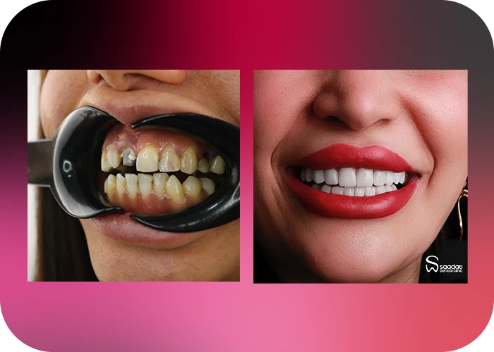 نمونه کار لمینت کلینیک دندانپزشکی سعادت - 3