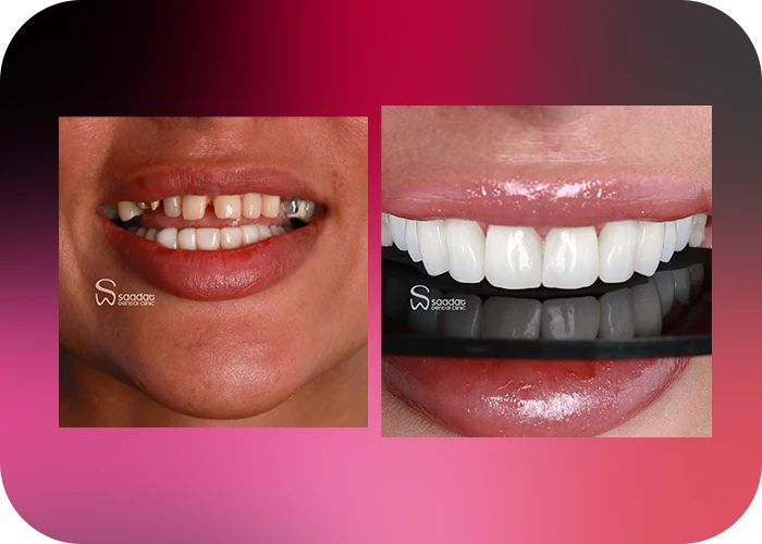 نمونه کار لمینت کلینیک دندانپزشکی سعادت - 1