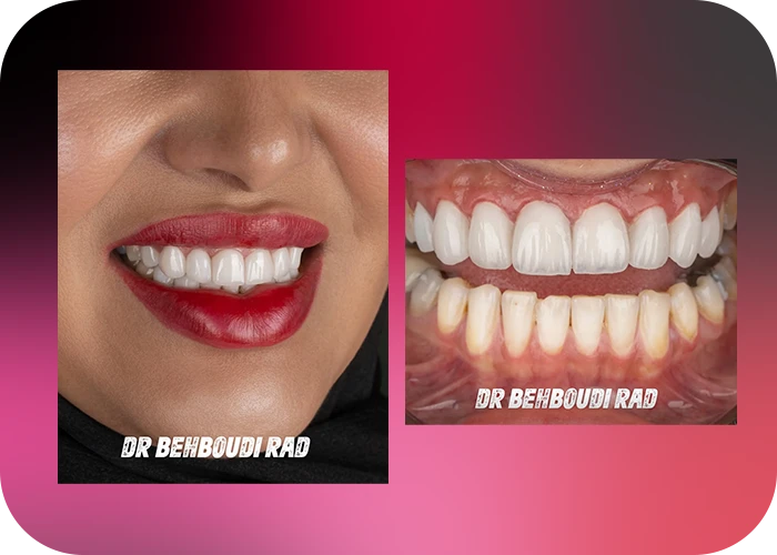 نمونه کار لمینت کلینیک دندانپزشکی دکتر هاجر بهبودی راد - 1