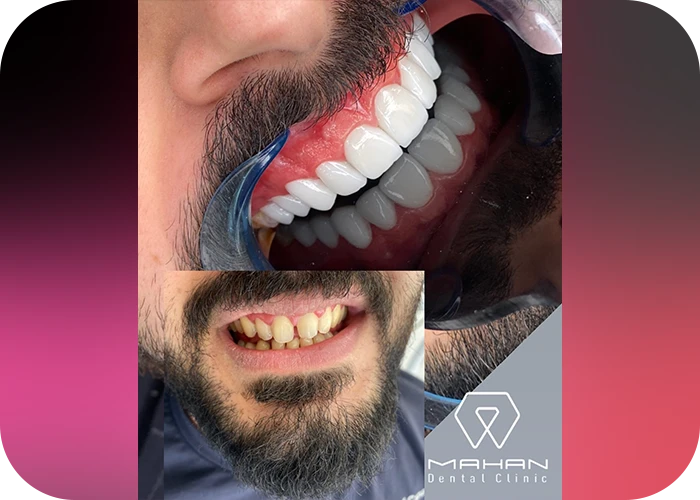 نمونه کار لمینت کلینیک دندانپزشکی ماهان - 3