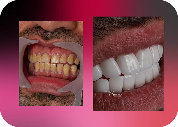 نمونه کار لمینت کلینیک دندانپزشکی سعادت - 5