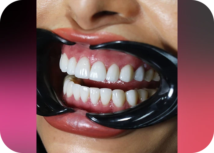 نمونه کار لمینت کلینیک دندانپزشکی بهار - 5