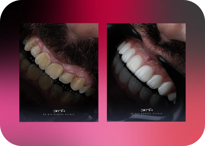 نمونه کار لمینت کلینیک دندانپزشکی دکتر نیک-5