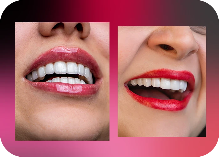 نمونه کار لمینت کلینیک دندانپزشکی دکتر یگانه موسوی زاده - 5