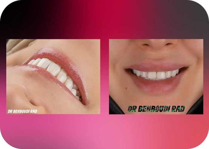 نمونه کار لمینت کلینیک دندانپزشکی دکتر هاجر بهبودی راد - 3