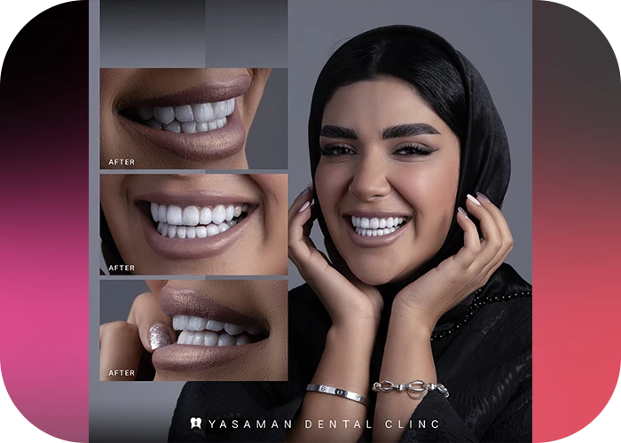 نمونه کار لمینت کلینیک دندانپزشکی یاسمن-5