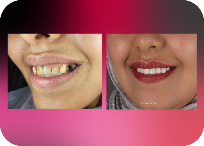نمونه کار لمینت کلینیک دندانپزشکی دکتر هاجر بهبودی راد - 5