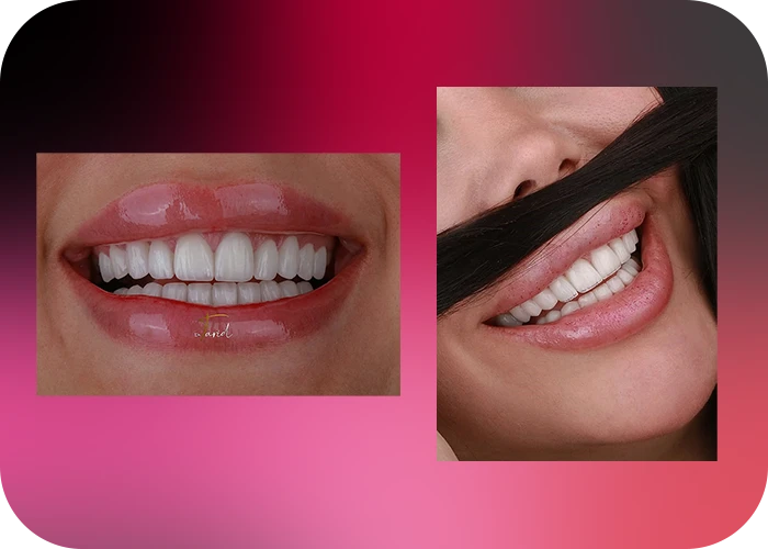 نمونه کار لمینت کلینیک دندانپزشکی دکتر فرید - 2