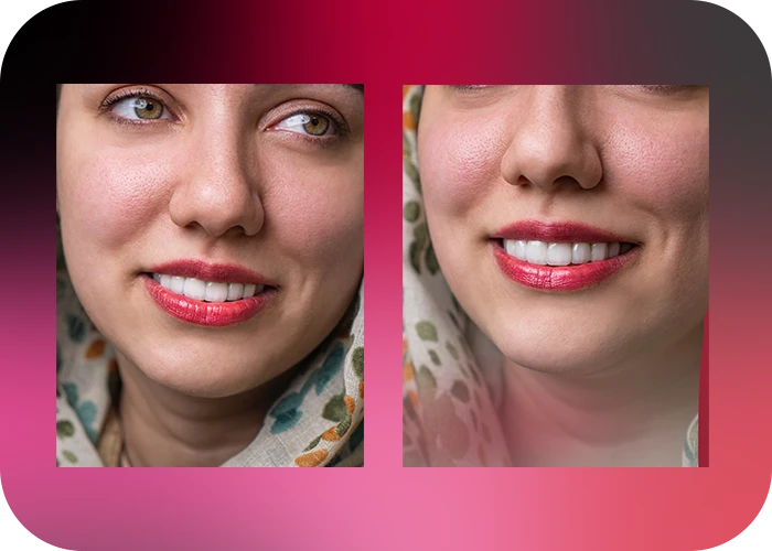 نمونه کار لمینت کلینیک دندانپزشکی دکتر یگانه موسوی زاده - 1